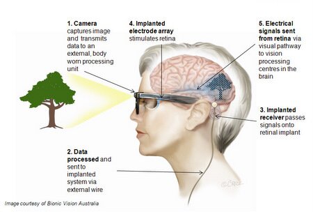 A diagram showing the wide-view device, which consists of camera mounted on a pair of glasses, the data is processed and sent to implanted system via external wire, the implanted receiver passes signals onto retinal implant, electrical signals sent from retina via visual pathway to vision processing centres in the brain.