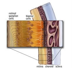 Retinal layers with retinitis pigmetosa A cross section showing the layers of a retina with retinitis pigmentosa, including the retinal ganglion cells, the bipolar cells, the rods and cones, choroid and sclera. The photoreceptors have begun to breakdown.