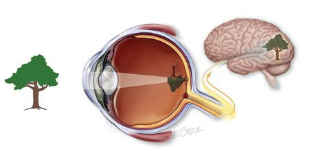 A cross-sectional diagram of how a healthy human eye sees - light enters the eye and is focussed on the retina. Receptors process the light into electrical signals which are transmitted to the brain along the optic nerve.