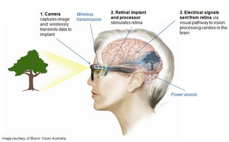 A diagram showing the high-acuity device, which consists of a camera mounted on a pair of glasses which wirelessly transmits data to impkant, retinal implant and processor stimulates retina, electrical signals sent from retina via visual pathway to vision processing centres in the brain.